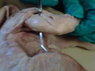 However, injure these muscles, and the athlete will have significant difficulty trying to perform. Thigh Muscles - ANATOMY: FETAL PIG DISSECTION