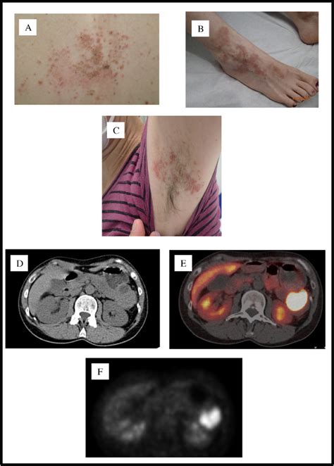 Necrolytic Migratory Erythema As A Cutaneous Manifestation Of A