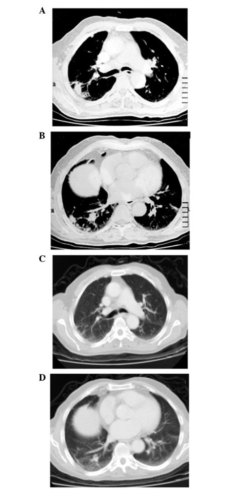 Initial Chest Computed Tomography Ct Scans Showing A And B Multiple