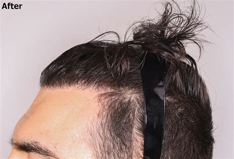 Frontal Hair Restoration With 3000 Fue Grafts Alviarmani Hair