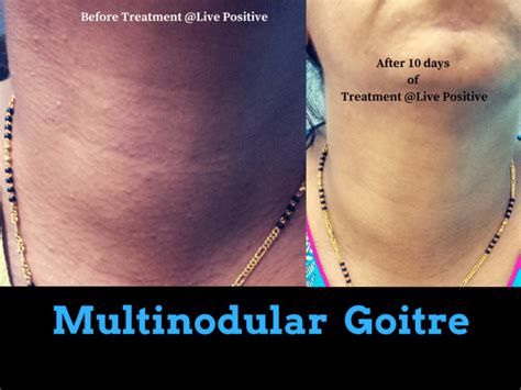 Multinodular Goitre Live Positive Multispeciality Homeopathy