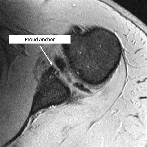 Axial Magnetic Resonance Imaging Scan Of The Right Shoulder Indicates