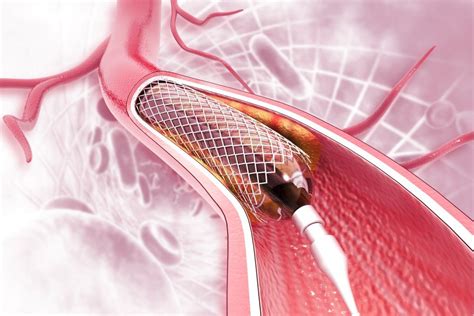 Coronary Artery Angioplasty Stenting In El Paso Tx
