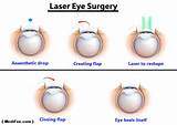 Pictures of Multifocal Lasik Eye Surgery