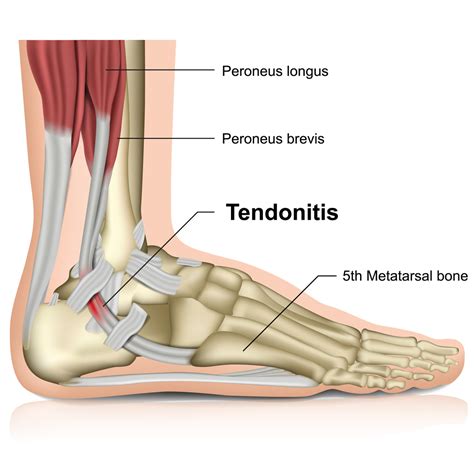 Ligaments and tendons are made of dense layered collagen fibers, called fibrous connective. What Is Peroneal Tendonitis? | Cincinnati Foot & Ankle Care