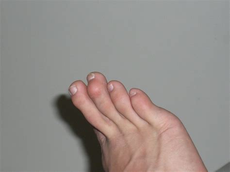 Hammer Toe Wikipedia