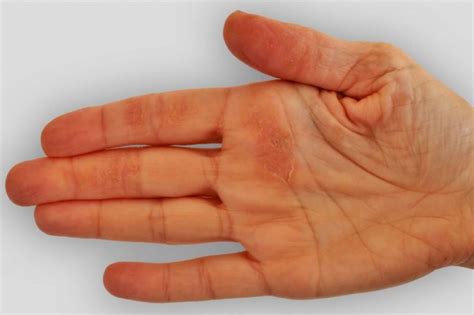 10 σημάδια στα χέρια που φανερώνουν σοβαρότερες παθήσεις και γιατί δεν