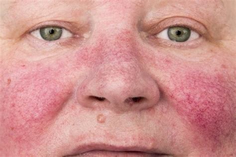 Skin Rash 14 Health Problems That Can Cause Red Spots Tua Saúde