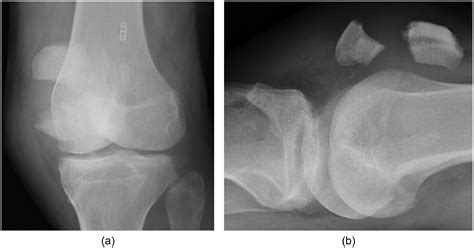 Operative Patella Fractureshould It Be Operatively Treated With A