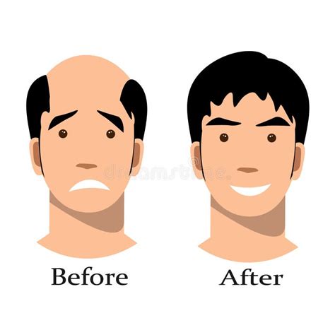 Male Baldness Pattern Stages Set Stock Vector Illustration Of