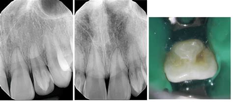 Endodontic Treatment Of Maxillary Incisor With Dens Invaginatus And