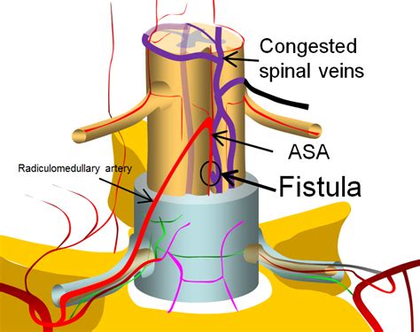 Spinal Intradural Pial Fistula
