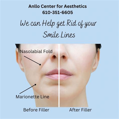 Smooth Out Your Nasolabial Folds And Marionette Lines
