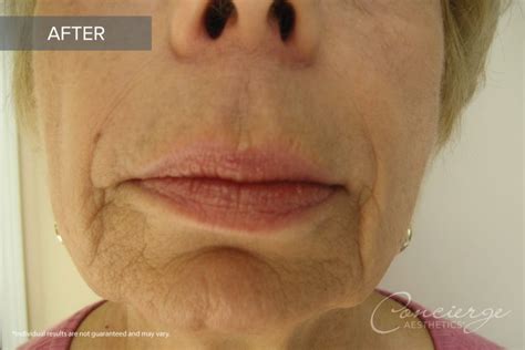 Before And After Photos Juvederm In The Lips Concierge Aesthetics
