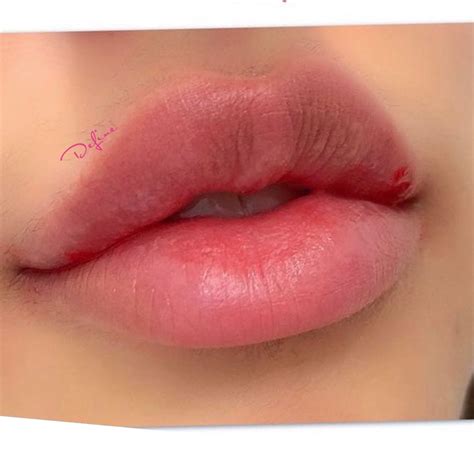 the perfect bow shaped lip 🎀 in 2021 lip augmentation dermal fillers lips lip fillers