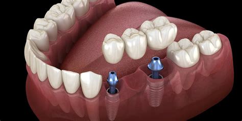 Dental Implants In Las Vegas NV Hybrid Dental Dental Implants In 89129