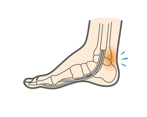 What Is A Posterior Ankle Impingement And What Are The Symptoms