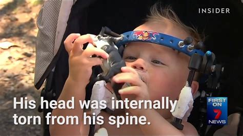 This Toddlers Head Was Miraculously Reattached To His Spine Youtube