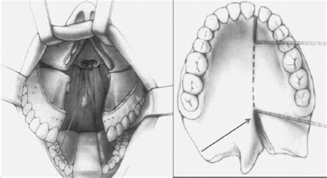 Representation Of A Hard And Soft Palate Incision Maxillary Division