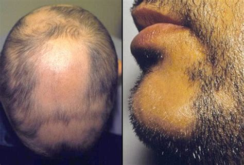 1.3.4 why do cats have bald spots near their. Alopecia Areata Picture Image on RxList.com