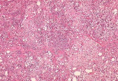 Pathology Outlines Granulomatous Inflammation