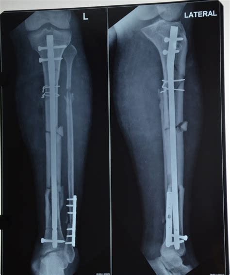 Leg Injury Open Fracture Tibia Grade Iii B Anterolateral Thigh
