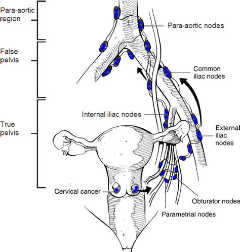 Figure 45 From Treatment Planning For External Beam Radiation Therapy