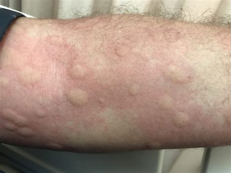 Natural Urticaria And Angioedema Treatment System Review Hives Gone