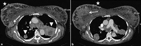 Ct Scan Features A Axial Contrast Enhanced Section Showing Diffuse