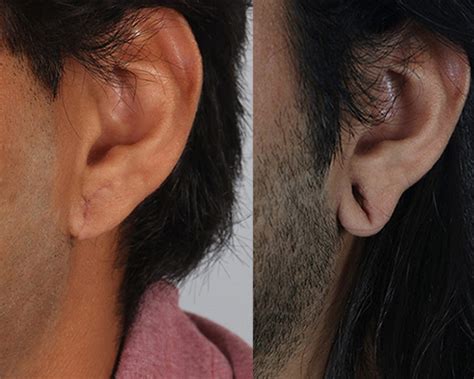Earlobe Repair And Reduction In The Woodlands Tx Dr Guy Facial