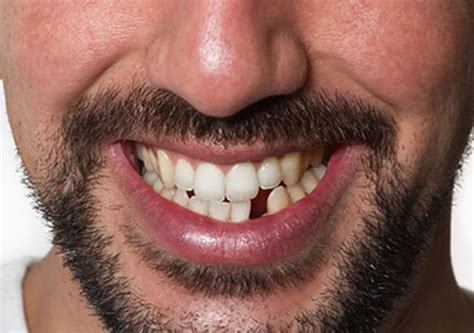 Chipped Tooth Garland Tx Broken Teeth Treatment Dental Filling