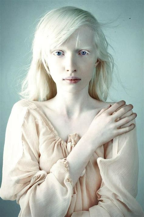 Nastya Kumarova For VOGUE Albino Girl Albinism Portrait