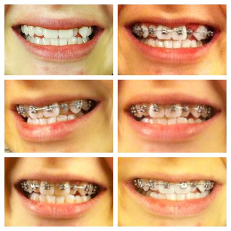 How Long After Getting Braces Can I Eat Recipe Collections