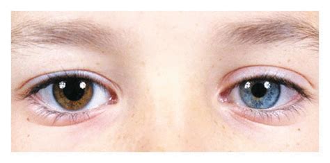 Medical Mystery — One Brown Eye And One Blue Eye Nejm