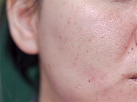 How To Get Rid Of Acne Scars According To A Dermatologist