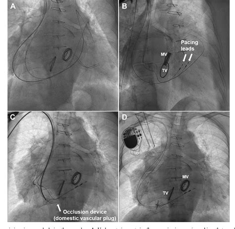Figure 2 From Implantation Of Right Ventricular Endocardial Pacing Lead