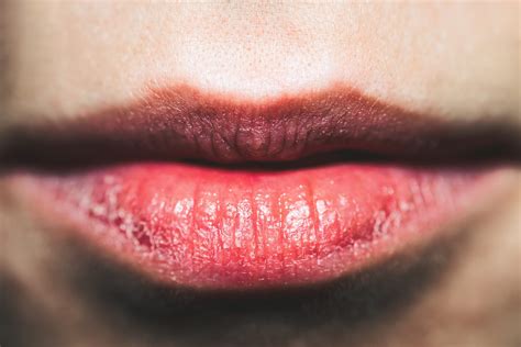 How To Get Rid Of Dry Chapped Lips