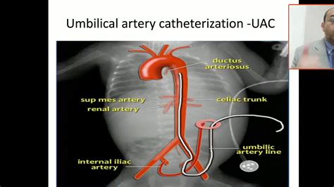 Umbilical Artery Catheter Anatomy Images And Photos Finder