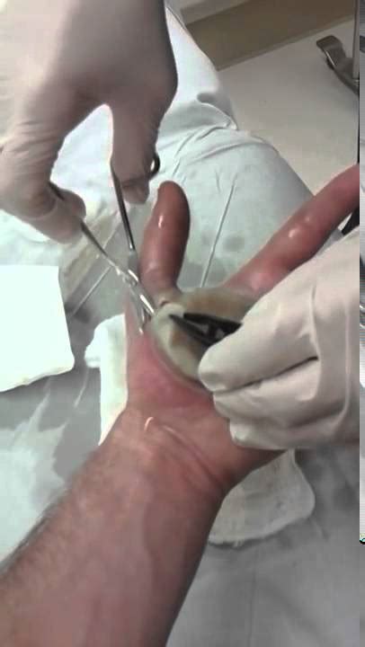 Blister That Covers Mans Entire Palm Being Popped Youtube