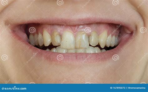 Smile With Ugly Crooked Yellow Teeth Stock Image Image Of Dentistry