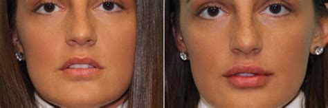 Injections Lip Augmentation Photos Chevy Chase Md Patient