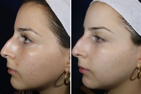 What To Expect When You Laser Away Your Acne Scars Into The Gloss
