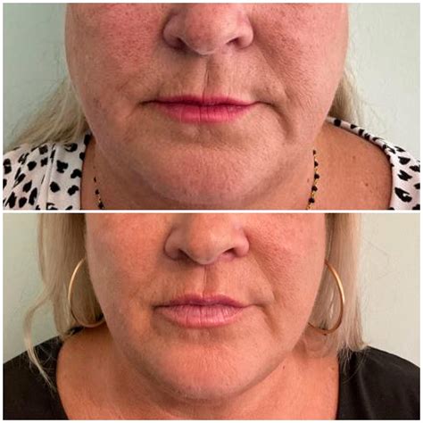 Surgical Lip Lift Ozark Facial Plastic Surgery And Aesthetics