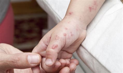 Can Children Get Shingles Yes But Theyre Preventable