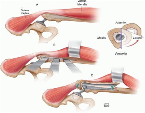 Extended Greater Trochanteric Osteotomies Musculoskeletal Key