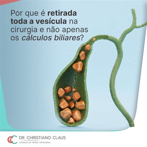 Em Relação A Vesícula Biliar é Incorreto