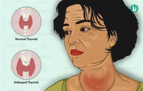 Understanding Goiter Causes Symptoms And Treatment