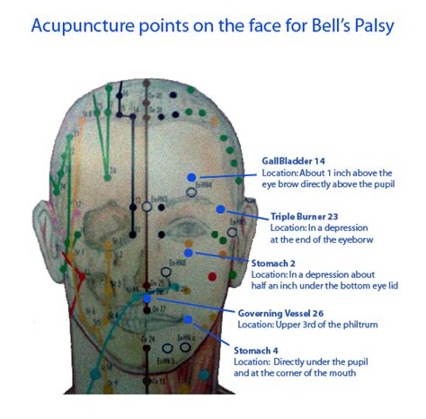 Acuthink Acupuncture For Bells Palsy