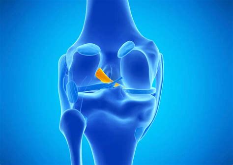 A network access control list (acl) is an optional layer of security for your vpc that acts as a firewall for controlling traffic in and out of one or more subnets. ACL Tear | Anterior Cruciate Ligament Injury | Knee ...