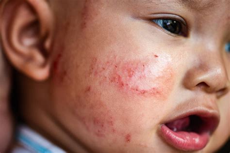 Itch No More Causes And Remedies For Eczema In Young Children Eat